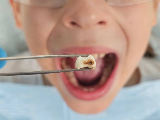 Best Emergency Wisdom Tooth Extraction in Northfield, OH